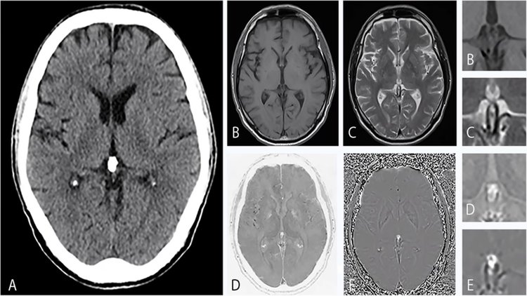 Imagerie médicale montrant une glande pinéale calcifiée au centre du cerveau